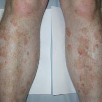 
	Schamberg disease