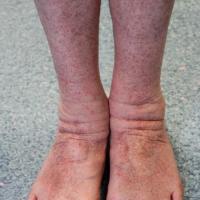 
	Itching purpura