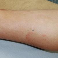 
	Majocchi's purpura