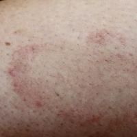 
	Same patient as previous image