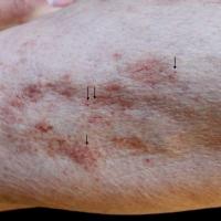 
	Schamberg disease&nbsp;

	Arrows denote cayenne…