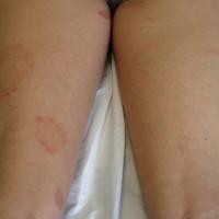 
	Majocchi's purpura