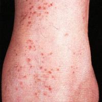 
	Gougerot-Blum syndrome