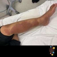 Cellulitis
Copied with kind permission from Skin…