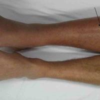 
	DVT