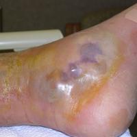 
	Necrotising fasciitis
	&nbsp;