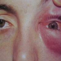 
	Orbital cellulitis - such patients need urgent…
