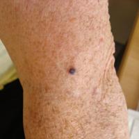 Angioma - clinically worrying, dermoscopy avoided…