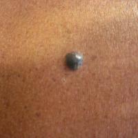 
	Angioma
	
	This black nodule gave cause for…