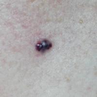 AngiomaAt first glance this lesion could appear…