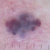 Angioma - dermoscopic image of previous…