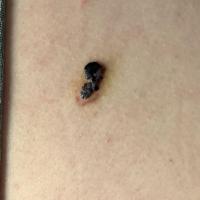 Angioma&nbsp;Thrombosed, and bled into the…