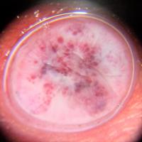 Cherry angioma