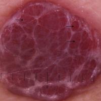 A cherry angioma - dermoscopic image of previous…