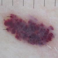 Angioma - dermoscopic image of previous…