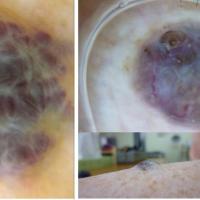 Angioma (left) versus melanoma (right)The lesion…