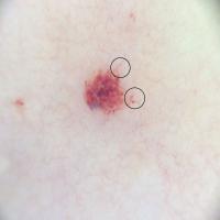 Cherry angioma with vessels at the edge…