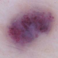 Cherry angiomaA little fuzzy but lacunae visible…