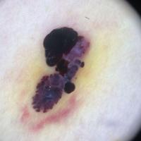 Dermoscopic image of previous…