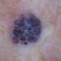 Cherry angioma, or in this case more of a…