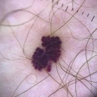 Cherry angiomaMultiple small red-purple…