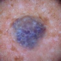 Angioma - another 'blackberry'&nbsp;As with…
