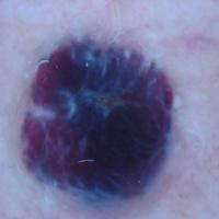 Dermoscopic appearance of previous…