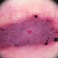 Angioma with partial thrombosis - dermoscopic…