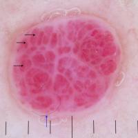 Cherry angioma - dermoscopic image of previous…