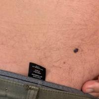 A thrombosed angiomaA long-term lesion that…