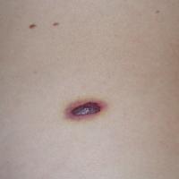 Traumatised angiomaThis had bled into the…