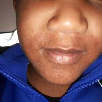 Childhood granulomatous periorificial…