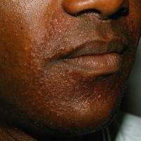 
	Childhood granulomatous periorificial…