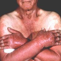 
	Chronic actinic dermatitis