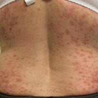 
	Chronic superficial scaly dermatitis with small…