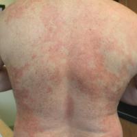 
	Chronic superficial scaly dermatitis -…