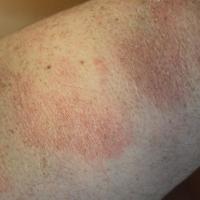 
	Close-up of the previous&nbsp;patient

	Fine…