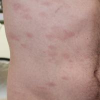 
	Chronic superficial scaly dermatitis with small…