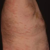 
	Chronic superficial scaly dermatitis&nbsp;with…