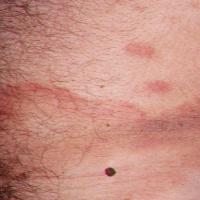 
	Early stage MF

	Large patches and polymorphous…