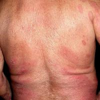 MFCopied with kind permission from Dermatoweb