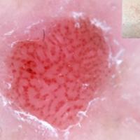 Clear cell acanthoma