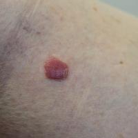 
	Clear cell acanthoma of Degos on the shin