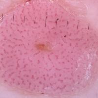 
	Dermoscopic appearance of same lesion showing…