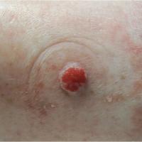 
	Clear cell acanthoma of Degos