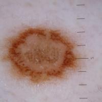 Dermoscopic appearance of previous figure&nbsp;
