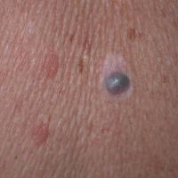 Nodular melanoma