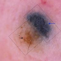 Dermoscopic appearance of previous…