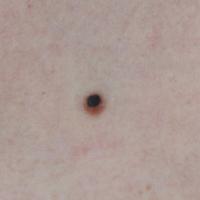 Combined naevusThis lesion, in a child, had…