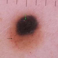Dermoscopic appearance of previous…